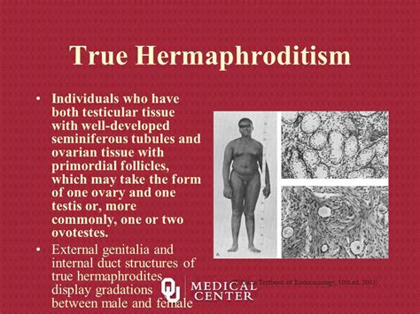 real hermaphrodite|True hermaphroditism: A nightmare for an adult : Current Urology .